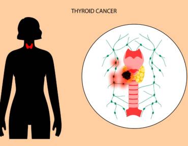 Δευτερογενείς συμπαγείς όγκοι: Συνηθισμένοι μεταξύ όσων εμφάνισαν καρκίνο του θυρεοειδούς μετά το Τσερνομπίλ!
