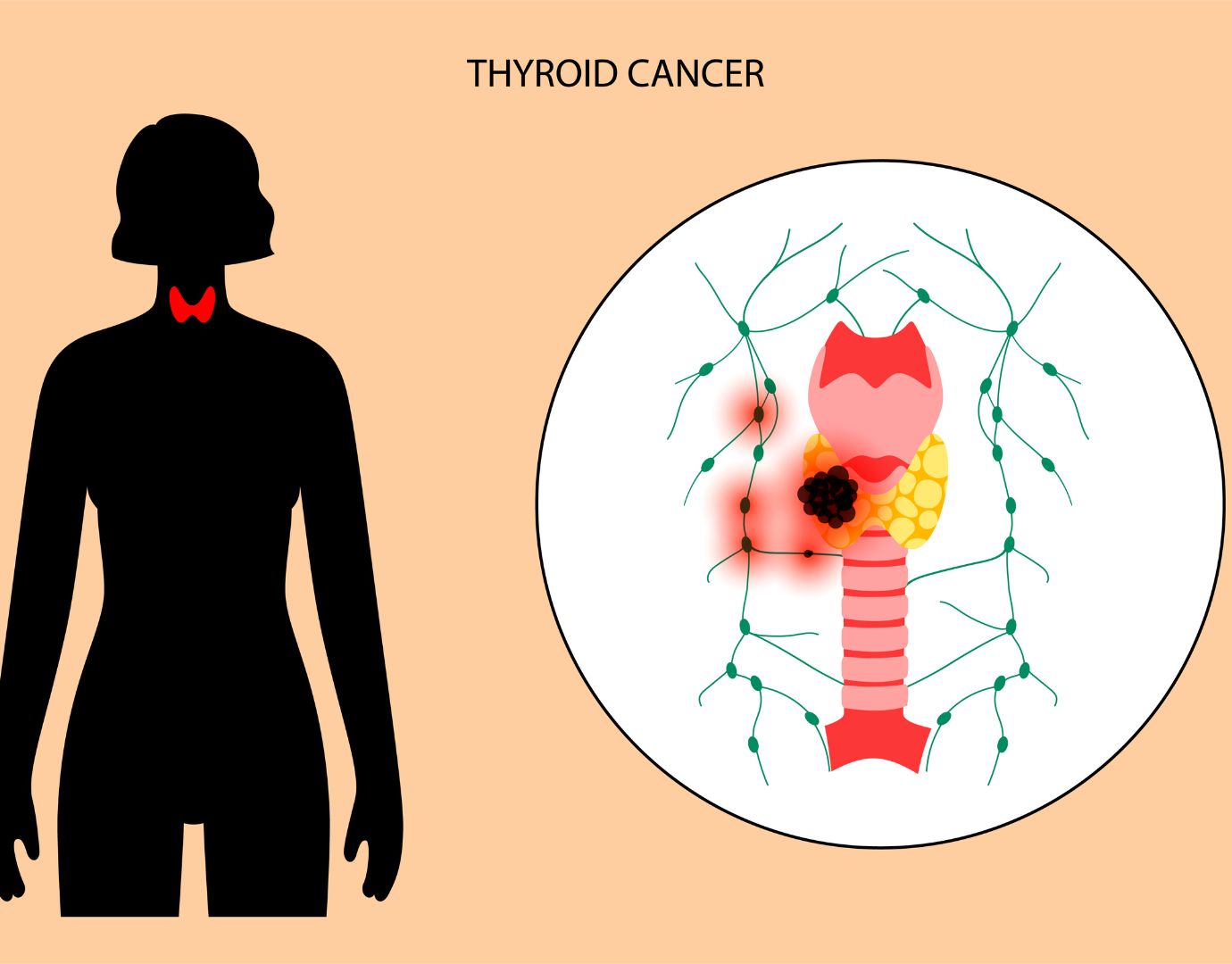 Δευτερογενείς συμπαγείς όγκοι: Συνηθισμένοι μεταξύ όσων εμφάνισαν καρκίνο του θυρεοειδούς μετά το Τσερνομπίλ!