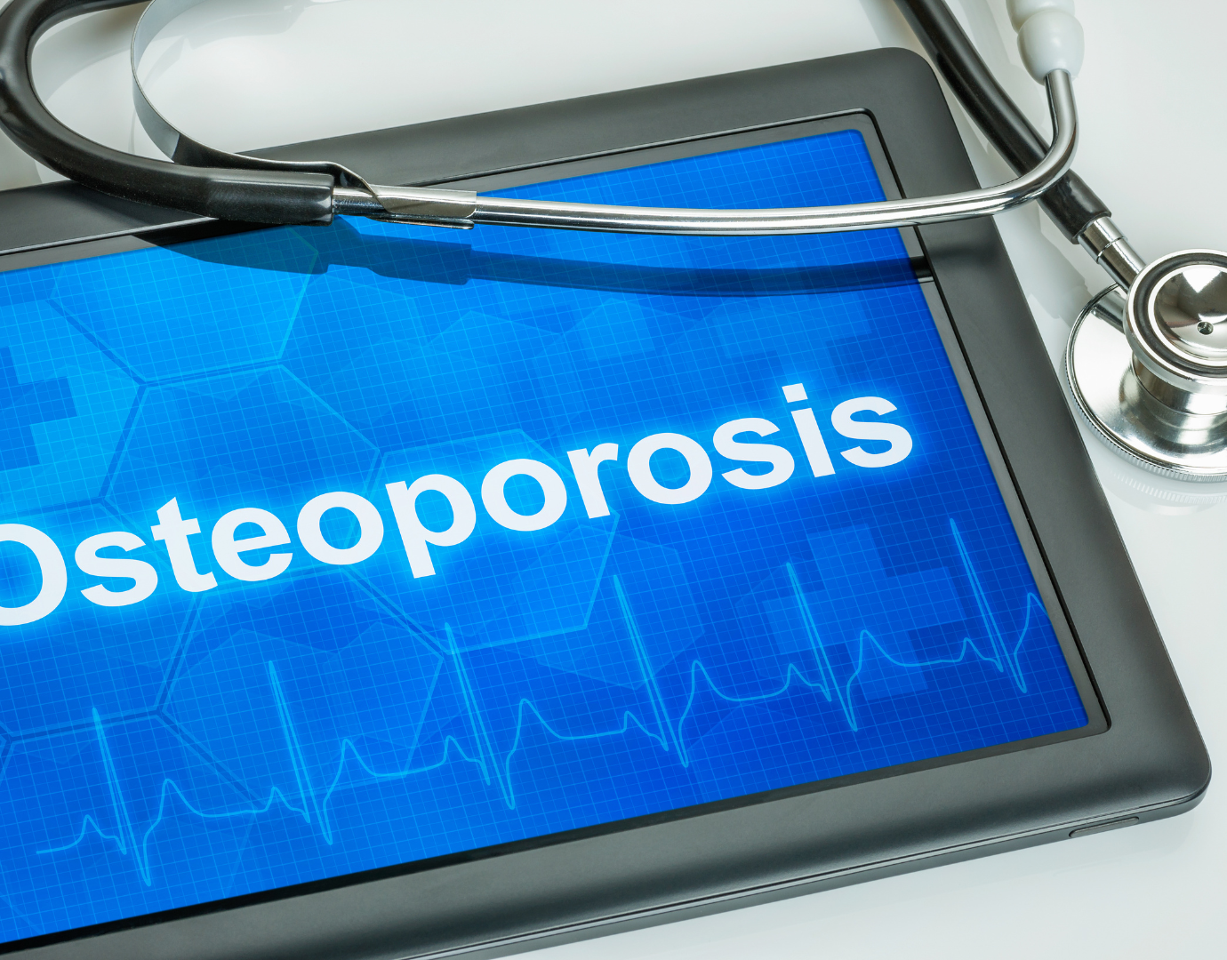 Θεραπεία Οστεοπόρωσης: Η Ελλιπής Αξιολόγηση των Δευτερογενών Αιτιών